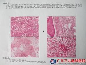 脑科肿瘤爆料案例最新,最新爆料揭示治疗挑战与希望  第3张 脑科肿瘤爆料案例最新,最新爆料揭示治疗挑战与希望  第3张